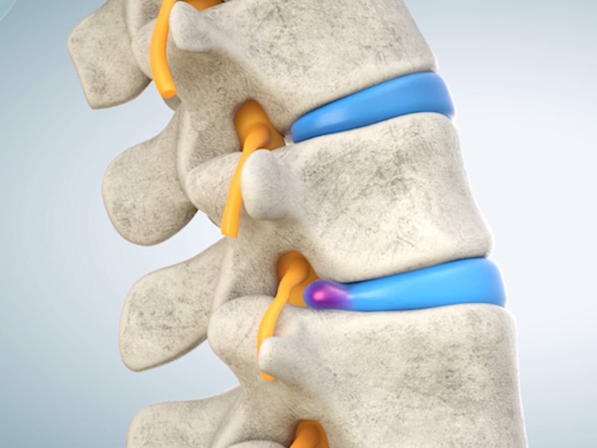 Back Pain