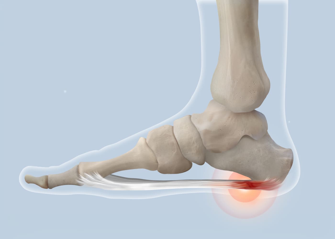 Plantar Fasciitis